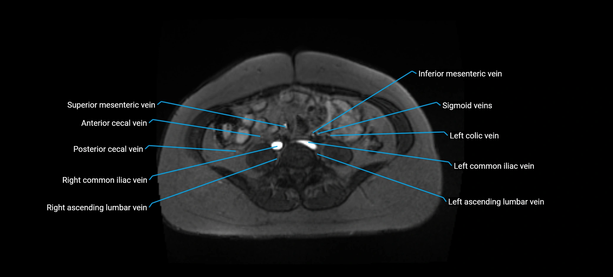 MRV abdomen pelvis & lower limb axial cross sectional anatomy labelled MRI image 121 (1).webp